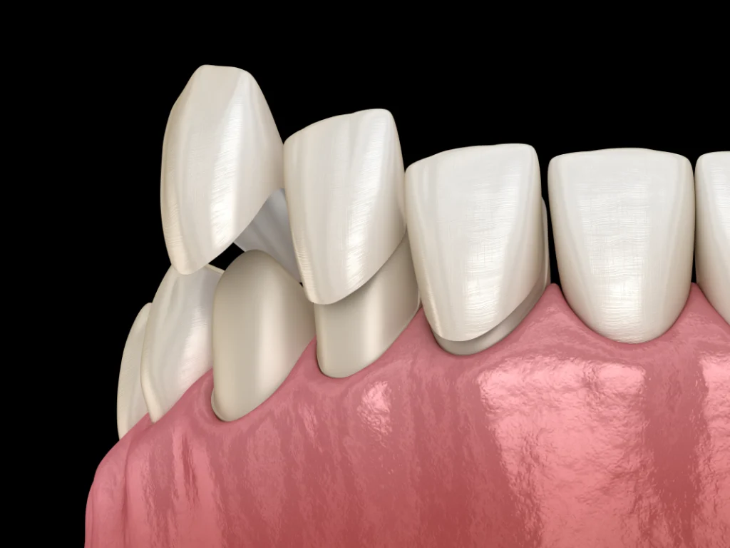 facettes dentaires veneers consultation dentiste Soins esthétiques Cabinet dentaire NACRE, Dentistes à Saint-Jacques-de-la-Lande