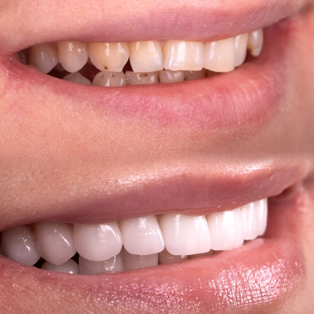 rennes facettes dentaires veneers Soins esthétiques Cabinet dentaire NACRE, Dentistes à Saint-Jacques-de-la-Lande