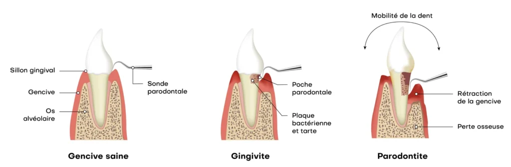 rennes soin gencives parodontologie rennes soin gencives parodontologie Parodontite : la maladie des gencives Cabinet dentaire NACRE, Dentistes à Saint-Jacques-de-la-Lande