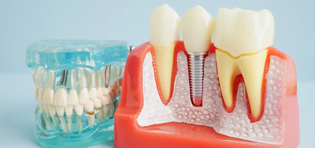 implant dentaire rennes Soins dentaires Cabinet dentaire NACRE, Dentistes à Saint-Jacques-de-la-Lande