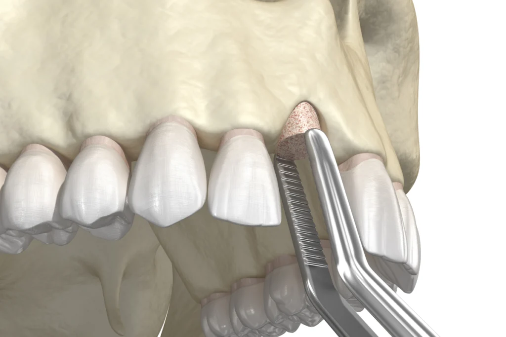 greffe osseuse chirurgie orale rennes greffe osseuse chirurgie orale rennes Soins chirurgicaux des gencives Cabinet dentaire NACRE, Dentistes à Saint-Jacques-de-la-Lande