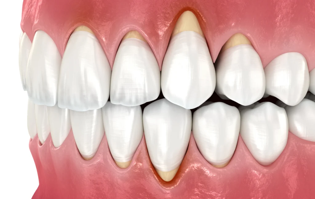 greffes gencive soin dentaire rennes greffes gencive soin dentaire rennes Soins chirurgicaux des gencives Cabinet dentaire NACRE, Dentistes à Saint-Jacques-de-la-Lande