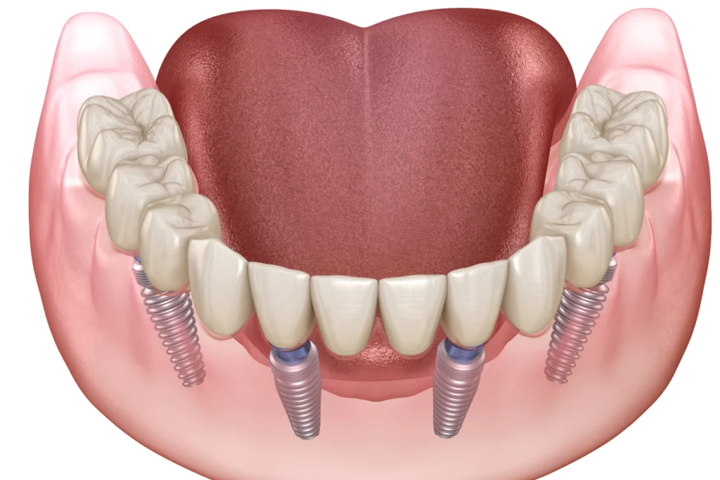 implant dentaire complet all on rennes Implants dentaires Cabinet dentaire NACRE, Dentistes à Saint-Jacques-de-la-Lande