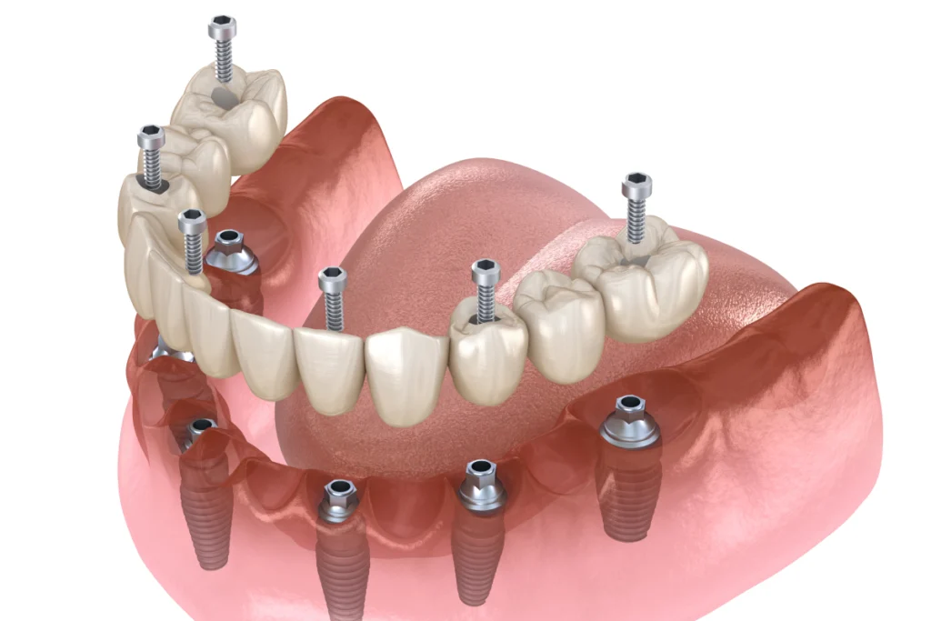 implant dentaire complet dentier rennes Implants dentaires Cabinet dentaire NACRE, Dentistes à Saint-Jacques-de-la-Lande