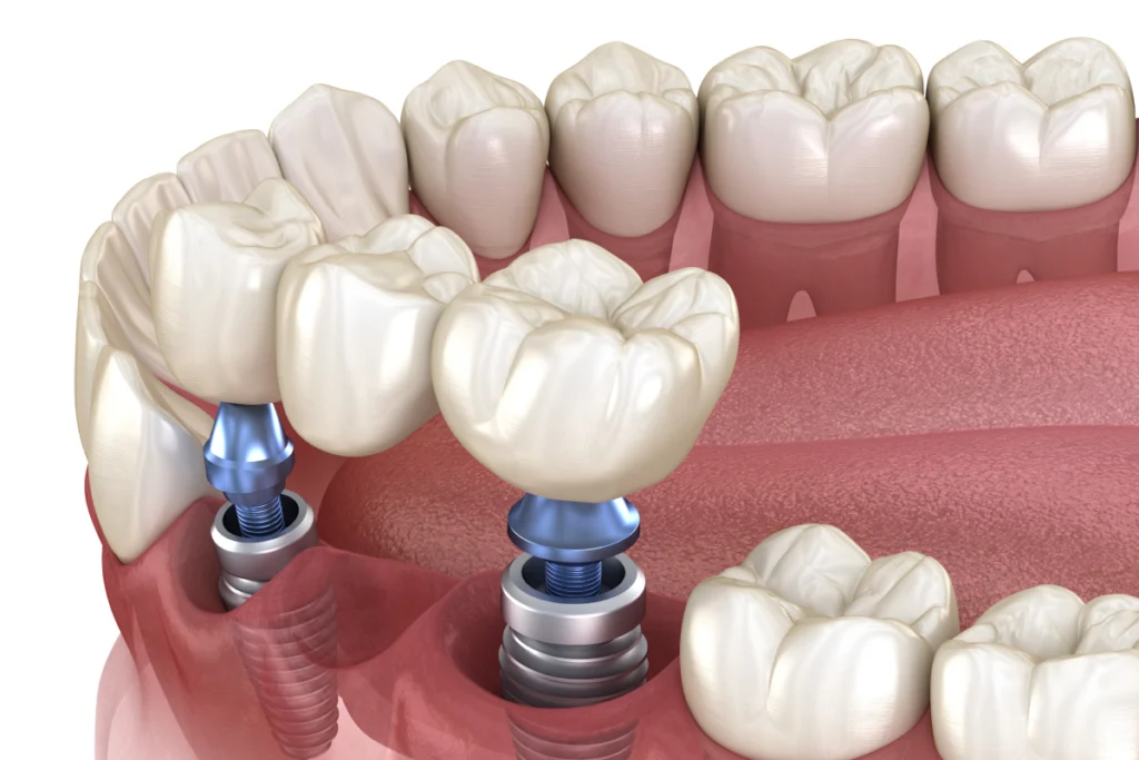 implant dentaire couronne bridge rennes Implants dentaires Cabinet dentaire NACRE, Dentistes à Saint-Jacques-de-la-Lande