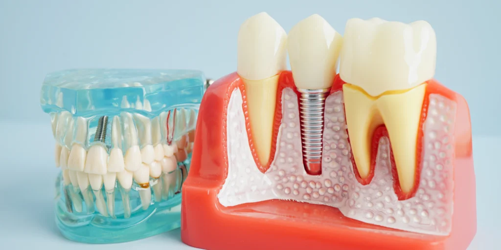 implant dentaire saint jacques de la lande Implants dentaires Cabinet dentaire NACRE, Dentistes à Saint-Jacques-de-la-Lande