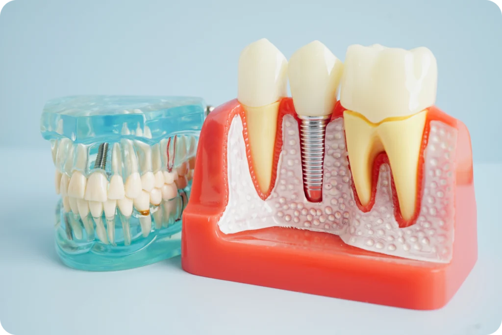 rdv dentiste redon implant dentaire Dentiste à Redon Cabinet dentaire NACRE, Dentistes à Saint-Jacques-de-la-Lande
